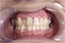 Dientes traumatizados y caries