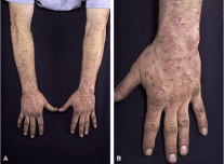 Pápulas eritematosas escoriadas con costras en extremidades superiores